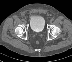 Minimal Bladder Wall Thickening - CTisus CT Scan