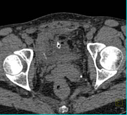 Blood in Pre-vesicle Space - CTisus CT Scan