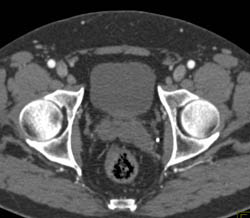 Enlarged Left Seminal Vesicle - CTisus CT Scan