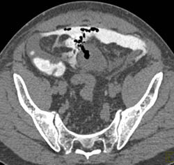 Perforated Bladder Due to Foley Catheter in A Patient With Cystitis - CTisus CT Scan