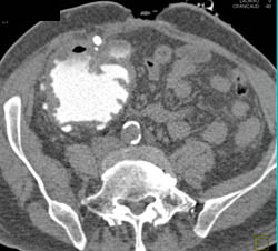 Neobladder S/P Cystectomy - CTisus CT Scan