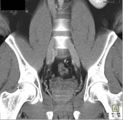 Enlarged Prostate and Seminal Vesicles - CTisus CT Scan