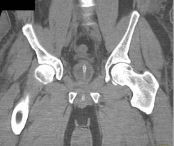 Ct Cystogram With Leak S/P Robotic Prostatectomy - CTisus CT Scan