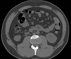 Enlarged Lymph Node Near Right Ureter - CTisus CT Scan