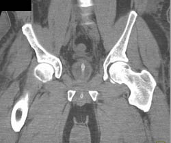 Bladder Perforation With CT Cystogram - CTisus CT Scan