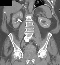 Bladder Cancer - CTisus CT Scan