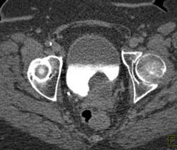 Enlarged Prostate Elevates the Bladder - CTisus CT Scan