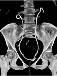 Normal CT Urogram and Cystogram - CTisus CT Scan