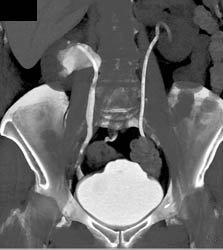 Normal CT Urogram and Cystogram - CTisus CT Scan