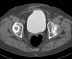 CT Cystogram With Fistulae to Colon - CTisus CT Scan