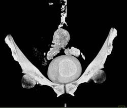 CT Cystogram With Fistulae to Colon - CTisus CT Scan