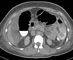 CT Cystogram With Fistulae to Colon - CTisus CT Scan