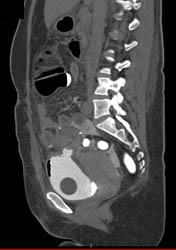 CT Cystogram With Fistulae to Colon - CTisus CT Scan