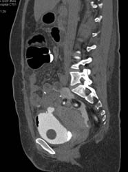 CT Cystogram With Fistulae to Colon - CTisus CT Scan