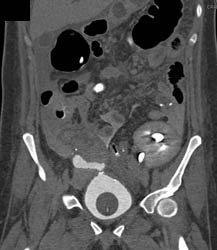 Perforated Bladder on CT Cystogram - CTisus CT Scan