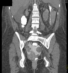 Perforated Bladder on CT Cystogram - CTisus CT Scan