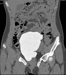 Augmented Bladder on CT Cystogram - CTisus CT Scan