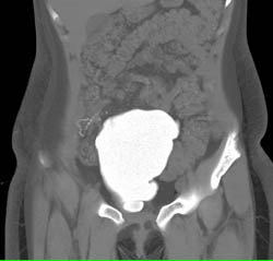 Augmented Bladder on CT Cystogram - CTisus CT Scan