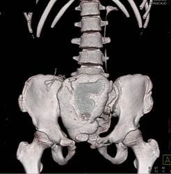 Augmented Bladder on CT Cystogram - CTisus CT Scan