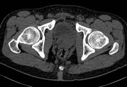 Subtle Bladder Cancer - CTisus CT Scan