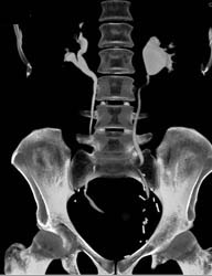 Subtle Bladder Cancer - CTisus CT Scan