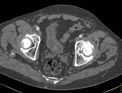 Subtle Bladder Cancer - CTisus CT Scan