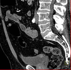 Subtle Bladder Cancer - CTisus CT Scan