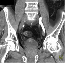 Subtle Bladder Cancer - CTisus CT Scan