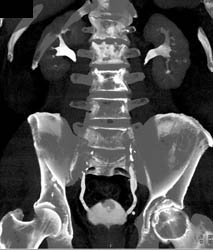 Subtle Bladder Cancer - CTisus CT Scan