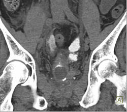 CT Cystogram With Fistulae to Bowel - CTisus CT Scan