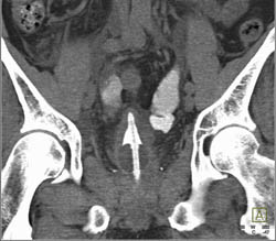 CT Cystogram With Fistulae to Bowel - CTisus CT Scan