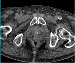 Prostatitis With Abscess - CTisus CT Scan