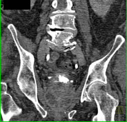 Prostatitis With Abscess - CTisus CT Scan