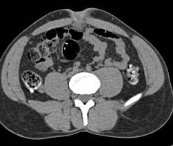 Infection in Urachal Remnant - CTisus CT Scan