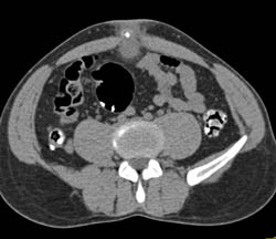 Infection in Urachal Remnant - CTisus CT Scan