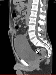 Infection in Urachal Remnant - CTisus CT Scan