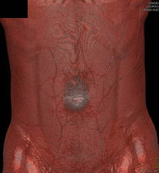 Infection in Urachal Remnant - CTisus CT Scan