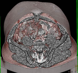 Infection in Urachal Remnant - CTisus CT Scan