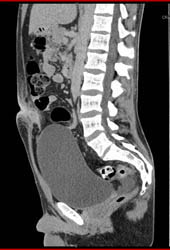 Infection in Urachal Remnant - CTisus CT Scan