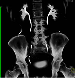 Infection in Urachal Remnant - CTisus CT Scan