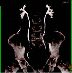 Infection in Urachal Remnant - CTisus CT Scan