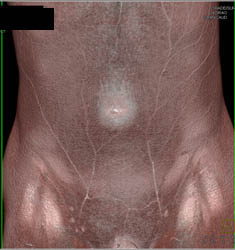 Infection in Urachal Remnant - CTisus CT Scan