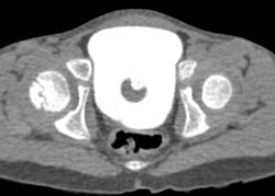 Normal CT Cystogram - CTisus CT Scan