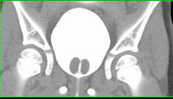 Normal CT Cystogram - CTisus CT Scan