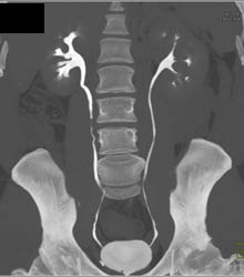 Normal CT Cystogram - CTisus CT Scan