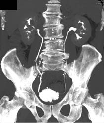 Thickening of Bladder Wall - CTisus CT Scan