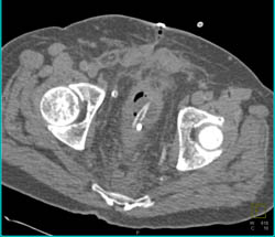 Thickening of Bladder Wall - CTisus CT Scan