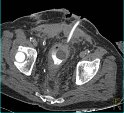 Thickening of Bladder Wall - CTisus CT Scan