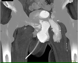 Fistulae to Thigh on CT Cystogram in Patient With Recurrent Tumor in Left Thigh - CTisus CT Scan