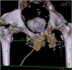 Fistulae to Thigh on CT Cystogram in Patient With Recurrent Tumor in Left Thigh - CTisus CT Scan